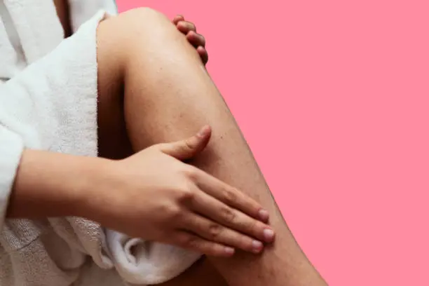 Causes of keratosis pilaris