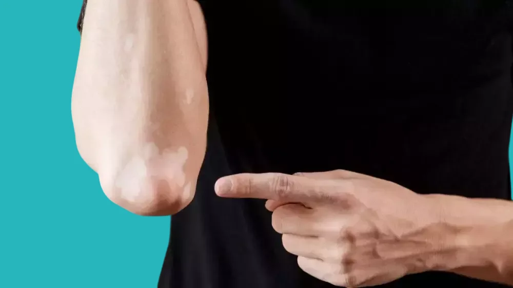 الكورتيكوستيرويدات لعلاج البهاق