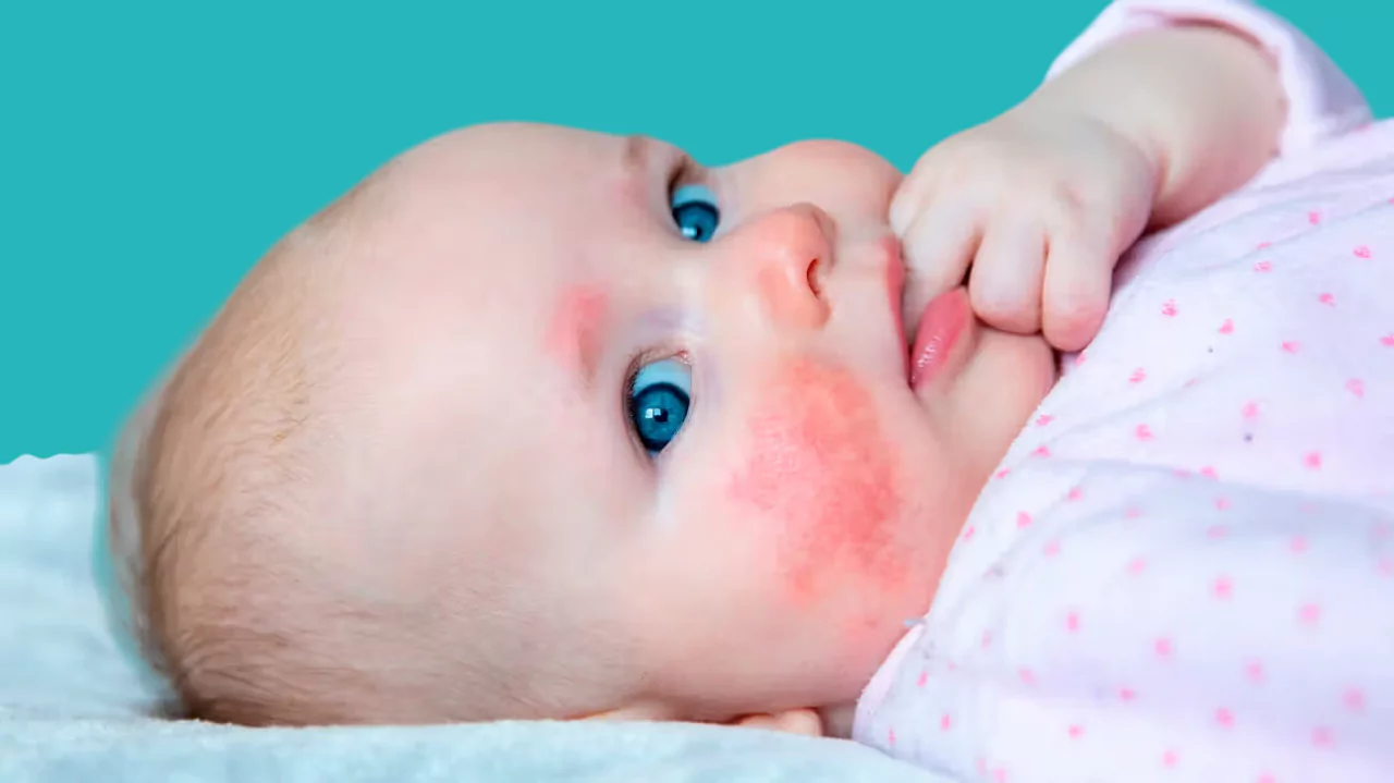 Milk Allergies