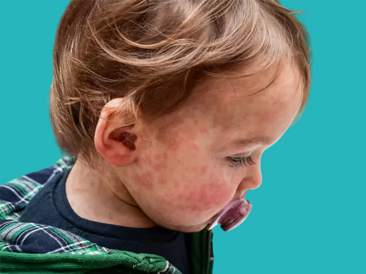 حساسية الطعام عند الاطفال