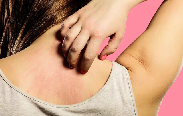 psoriasis 
