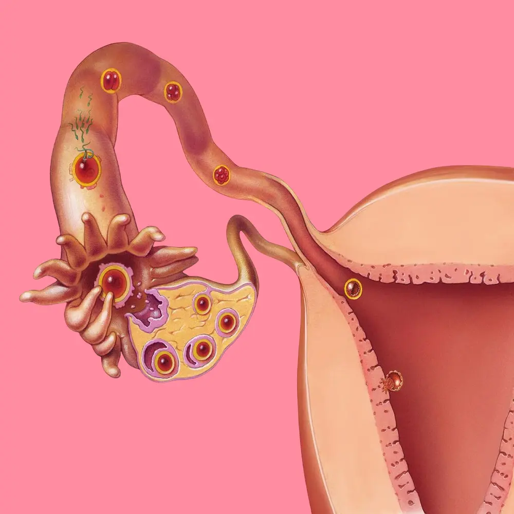 Causes of infertility in women and ways to treat it 