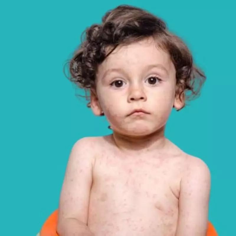 How to protect a child from measles 