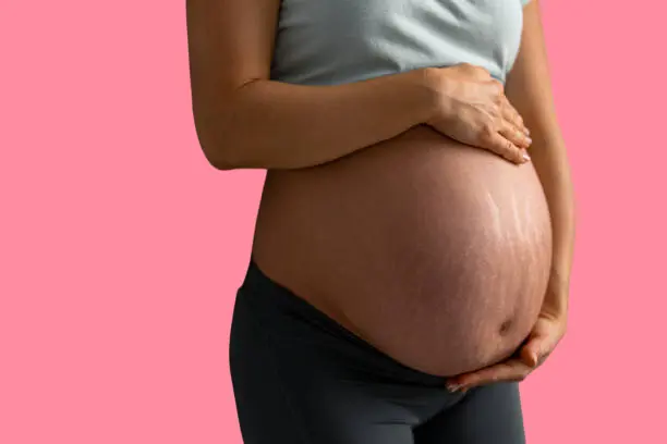 علامات التمدد في البطن بعد الولادة