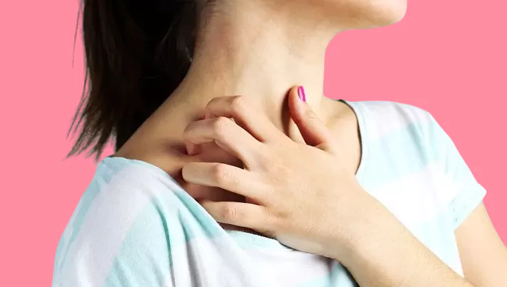 Eczema 