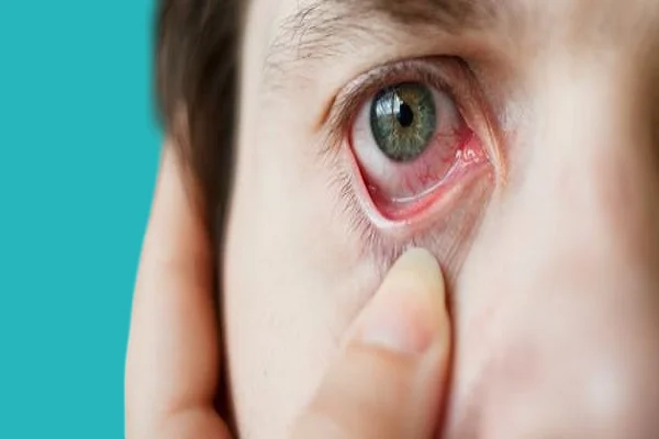 احمرار في العين من اعراض حساسية العين 