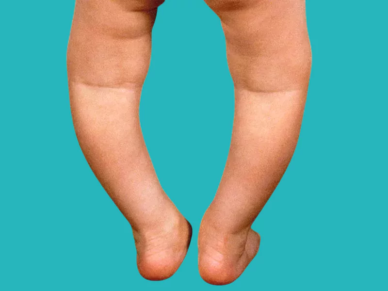 rickets and osteomalacia